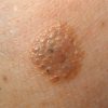 Способы удаления папиллом: какой лучше и безопасней