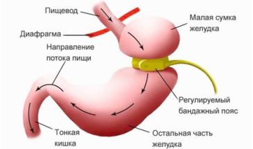 Операция на желудок для похудения что нужно знать